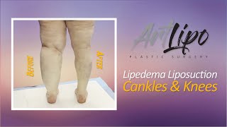 Lipedema  Leg Liposuction Results  Lipo 360° Cankles amp Knees  Expert Dr Thomas Su [upl. by Hurlow]