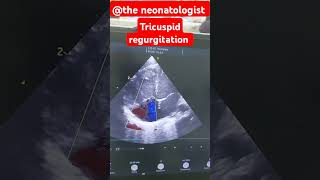 Tricuspid regurgitation neonate echo neonates neonatology echo [upl. by Nonnah]