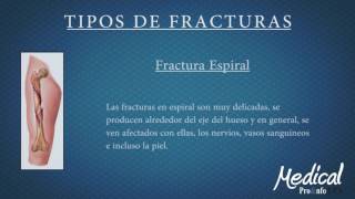 Tipos de Fracturas Clínica Medica SAS [upl. by Ekram324]