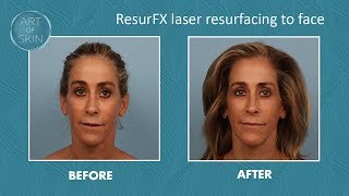 ResurFX minimal downtime laser resurfacing [upl. by Llertac]