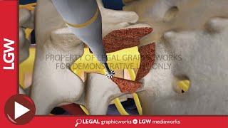 Lumbar Fusion of L5  S1 transforaminal interbody animation recreation [upl. by Ahseinat]