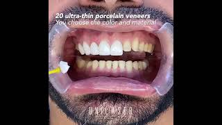 Porcelain veneers This is how we do it [upl. by Demitria]