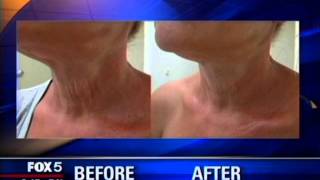 ClearLift on Good Day NY [upl. by Elbag]