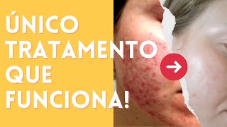 Quais Produtos Usar para ELIMINAR A ACNE FÚNGICA  Rotina passo a passo para limpar sua pele ✨ [upl. by Elene299]