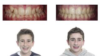 Tratamiento de ortodoncia con brackets en dos fases [upl. by Noram]