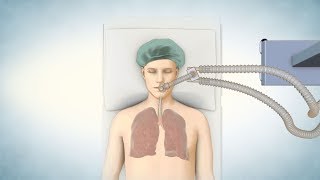 Lung Transplant Process [upl. by Ellon]