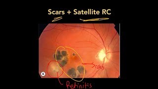 High Yield Topic Ocular Toxoplasmosis [upl. by Nebe]