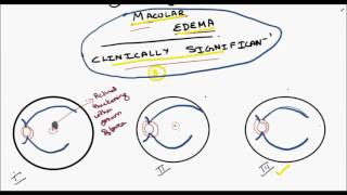 clinically significant macular edema [upl. by Adnamas593]