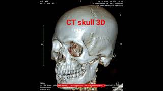 CT scan skull 3D face [upl. by Mungovan]