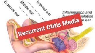 Recurrent Otitis Media [upl. by Shalom]