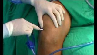 Septic arthritis of the knee arthroscopic debridement [upl. by Hazel862]