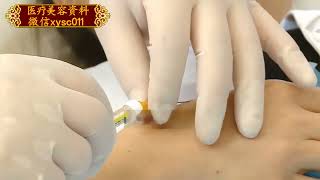 李吉民 ：手部抗衰注射法 Li Jimin Antiaging injection method for hands [upl. by Gernhard617]