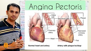 Angina Pectoris  Basic Introduction and Pathophysiology of Angina Pectoris Hindi amp English [upl. by Aikimat]