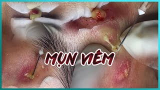 Big Cystic Acne Blackheads Extraction Blackheads amp Milia Whiteheads Removal Pimple Popping [upl. by Ykroc]