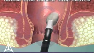 Infrared Coagulation Therapy for Hemorrhoids  3D Medical Animation [upl. by Niroc399]