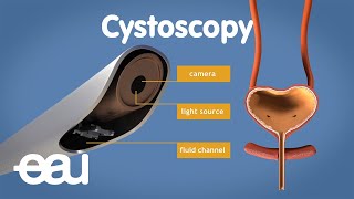 Cystoscopy overactive bladder [upl. by Alicirp]