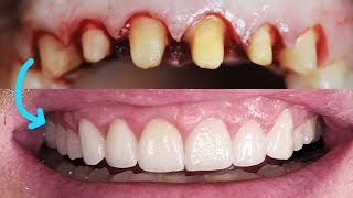 Front Tooth Crowns Before amp After Cosmetic Dentist Smile Makeover EMAX Preparation Remove Veneers [upl. by Venezia]