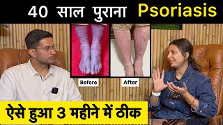 Psoriasis Treatment In Hindi Ft upasanakiduniya  Skin Disease  Himanshu Bhatt [upl. by Otirecul]