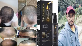 dont use trichospire hair growth serum  honest review [upl. by Natsyrk]