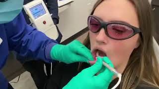 Laser treatment for cold sores and canker sores [upl. by Aihsekin465]