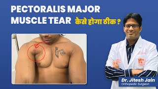 Pectoralis Major Muscle Tear कैसे होगा ठीक  Bench Press Injury  Dr Jitesh Jain [upl. by Leilamag]