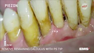 Dentální hygiena  EMS ultrazvuk [upl. by Suirtemed]