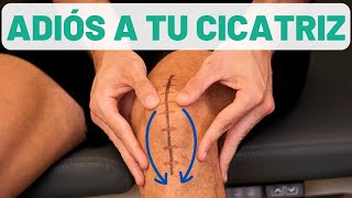 ¿Cómo QUITAR CICATRICES ⚡ EN CASA con 1 MASAJE [upl. by Ydnil]