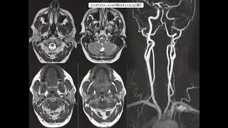 Case 98 with Horners syndrome [upl. by Ateekal]