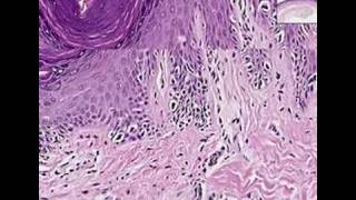 Histopathology SkinMelanoma in situ [upl. by Hardej]