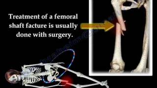 Fracture of the Femur and its fixation  Everything You Need To Know  Dr Nabil Ebraheim [upl. by Rushing]