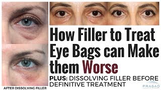 How Under Eye Fillers can Make Prominent Eye Bags Worse and Safely Dissolving Filler [upl. by Agle753]