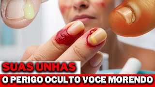 Paroníquia O Perigo Oculto nas Suas Unhas SAUDE PORQUE [upl. by Aiek237]