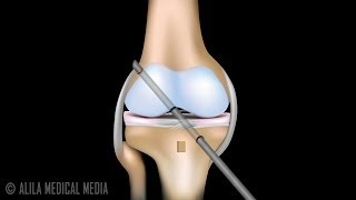 ACL Reconstruction Surgery Animation [upl. by Bekelja]