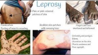 Leprosy  leprosy treatment  Leprosy pathology  hensens disease  leprosy disease [upl. by Gyasi581]