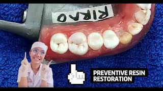 PEDO Preventive Resin Restoration [upl. by Anuahsed]