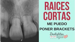 RAICES CORTAS Y ORTODONCIA  Me puedo poner brackets  Reabsorción Radicular [upl. by Delmar]