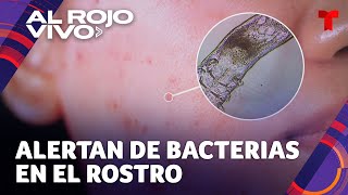 Alerta por bacterias en la cara que podrían afectar la salud de la piel [upl. by Nicholle277]