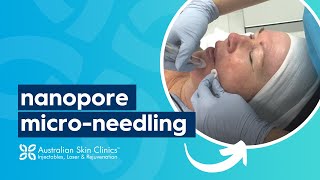 Nanopore MicroNeedling  Australian Skin Clinics [upl. by Aoht]