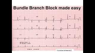 bundlebranchblock [upl. by Gaidano396]