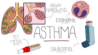 Asthma Explained Including Pathophysiology [upl. by Neirda754]