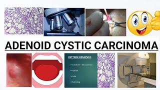 ADENOID CYSTIC CARCINOMA  COMPLETE DISCUSSION  IMAGES [upl. by Fernas916]