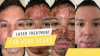 STRONGEST LASER TREATMENT FOR ACNE SCARS IS ROHRER AESTHETICS FULLY ABLATIVE CO2  Dr Jason Emer [upl. by Sadira]