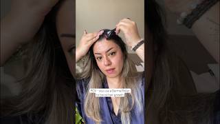 Derma Roller hair growth results are amazing Hair regrowth journey with derma roller 05 haircare [upl. by Naoj]