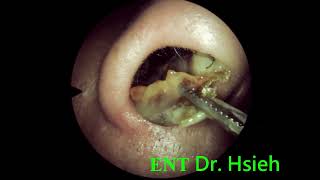 ENT local treatment after RT 3 weeks 010 鼻中膈鼻道成形手術術後三週耳鼻喉局部治療 [upl. by Sirhc23]