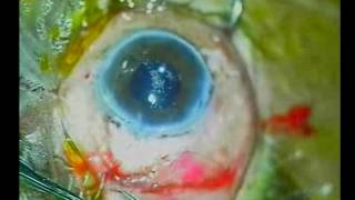 Releasable amp Conjunctival Mattress suture in PhacoTrabeculectomy [upl. by Arrio]