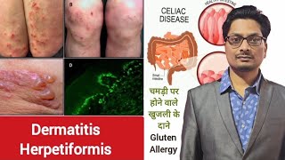 Dermatitis Herpetiformis  Celiac Disease  चमड़ी पर होने वाले खुजली के दाने  Gluten Allergy itch [upl. by Nwahsor]