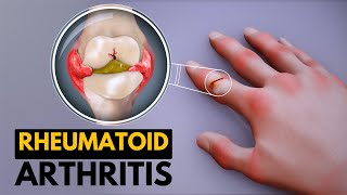 Rheumatoid Arthritis Causes Signs and Symptoms Diagnosis and Treatment [upl. by Ninehc]