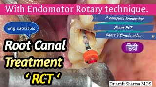 Root Canal Treatment step by step  on patient  RCT  रूट केनाल ट्रीटमेंट  Single visit RCT [upl. by Ragas]