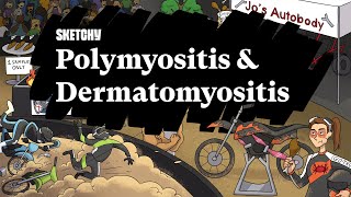 Path Study Guide Polymyositis amp Dermatomyositis Full Lesson  Sketchy Medical  USMLE Step 1 [upl. by Ponce]