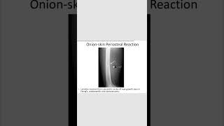 Onion skin periosteal reactionrevision neetpg inicet [upl. by Nyltac]